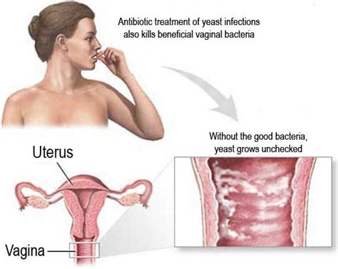 What Does A Yeast Infection Look Like What Does It Look Like Find Out Here