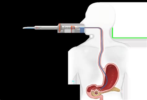 Eus Rfa Endoscopic Rf Ablation Starmed America