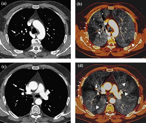 Thoracic Applications Of Dual Source Ct Technology European Journal