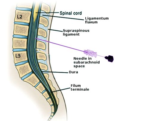 Figure Anatomy Of The Distal Lumbar Spine Image Courtesy S Bhimji Md