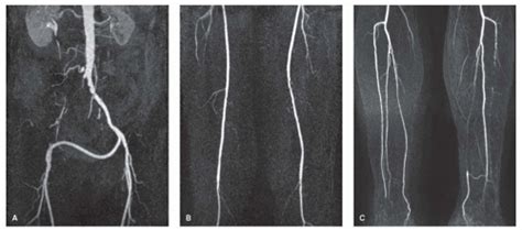 Magnetic Resonance And Computed Tomography Angiography Of Peripheral