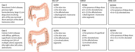 Development and validation of a novel Endoscopic ulcer Activity Score