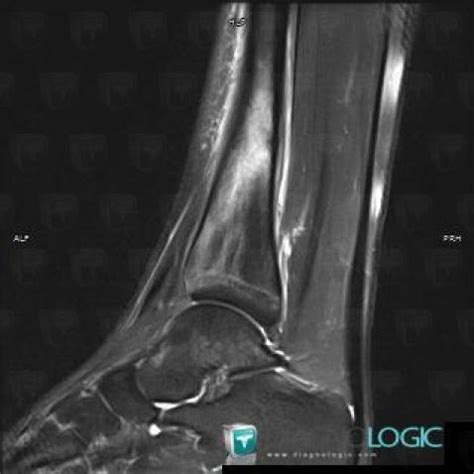 Radiology Case Stress Fracture Mri Diagnologic