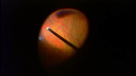 Vitreous Hemorrhage From Retinal Tear Caused By Posterior Vitreous