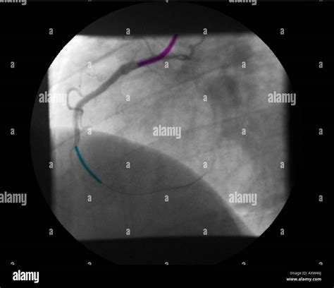 Stent Coronaria Angioplastia Fotograf As E Im Genes De Alta Resoluci N