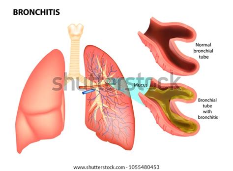 Bronchitis Normal Bronchial Tube And Bronchial Stock Vector Royalty