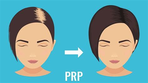 What Is Platelet Rich Plasma Therapy And Can Prp Help Treat Hair Loss