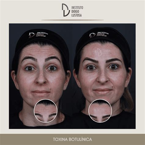 Botox Toxina Botulínia Instituto Diogo Lustosa