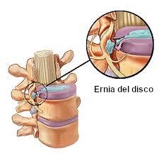 Ernia Del Disco Sintomi Tipologie E Terapie Efficaci Osteolab