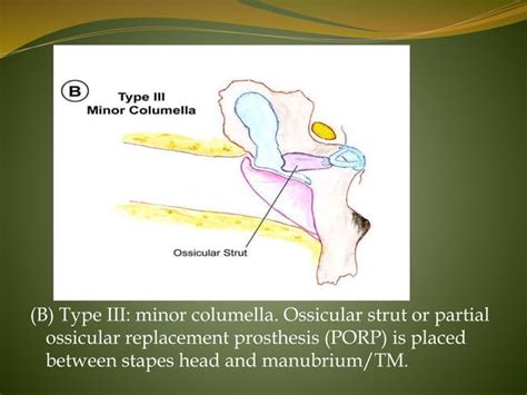 Tympanoplasty; Indications, types, anesthesia, surgical procedure.