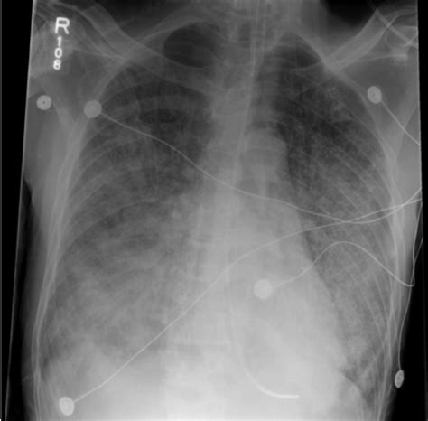 Chest Radiograph Showing Bilateral Diffuse Interstitial Infiltrates And