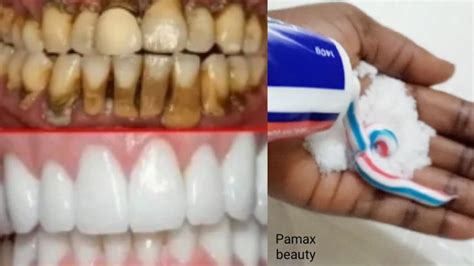 In 2 Minutes Whiten Your Teeth Remove Stain And Odour Teeth Stain