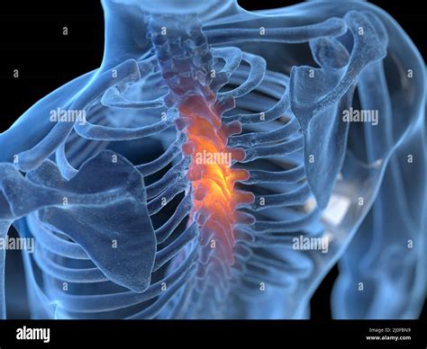 Painful thoracic spine, illustration Stock Photo - Alamy