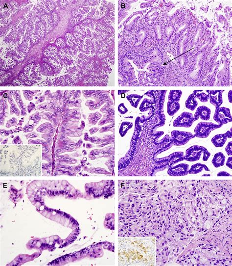 Peutz Jeghers Syndrome Surgical Pathology Clinics