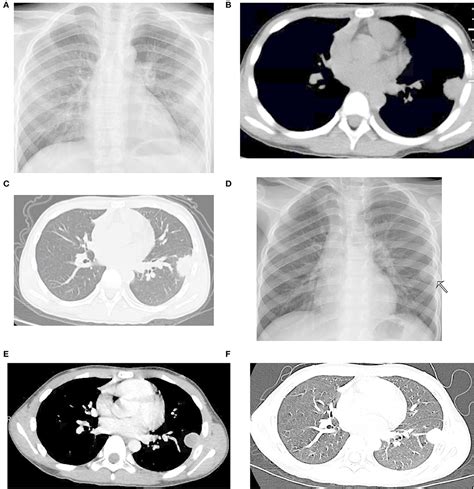 Frontiers An Isolated Pulmonary Nodule Secondary To Streptococcus Intermedius Infection In An