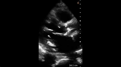 Aortic Stenosis Ultrasound Image Interpretation Youtube