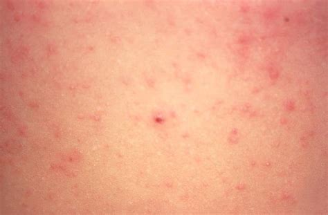 Scabies On Back