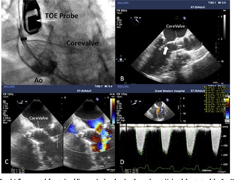 Figure 1 From Iatrogenic Mitral Stenosis Following Transcatheter Aortic