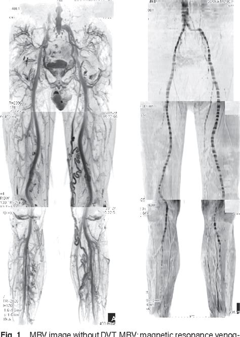 Figure From Mr Venography For The Assessment Of Deep Vein Thrombosis