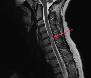 Cervical Myelopathy – cheshirespine.com