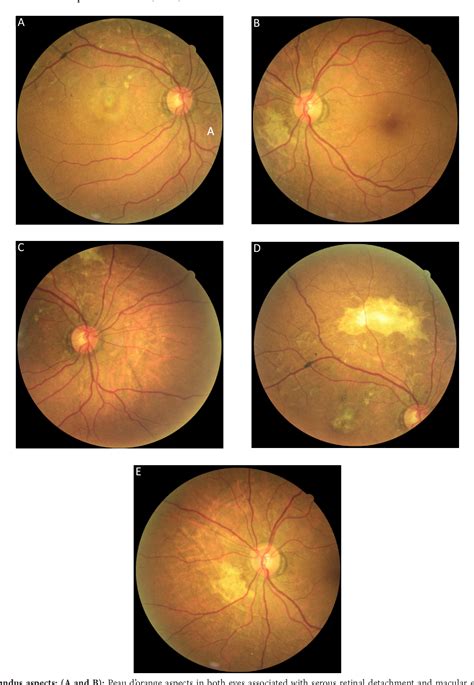 Figure 1 From Optical Coherence Tomography Angiography For Choroidal Neovascularization And