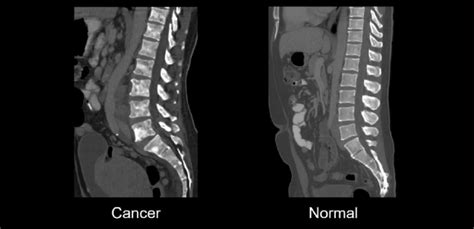 Abdominal Ct Bones • Litfl • Radiology Library