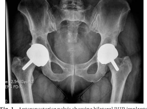 Figure 1 From Inflammatory Pseudotumor Causing Deep Vein Thrombosis After Metal On Metal Hip