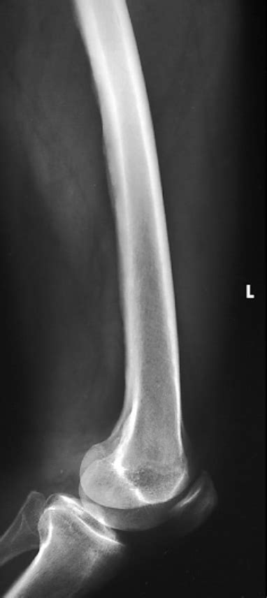 Mediolateral Distal Femur Diagram Quizlet