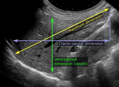 MEDICAL ULTRASOUND/HEPATOMEGALY