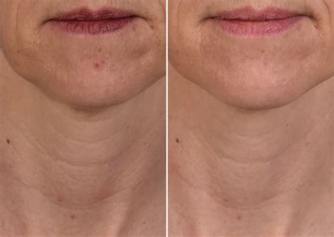 Skinpen® Microneedling Photos Houston Tx Patient 13660