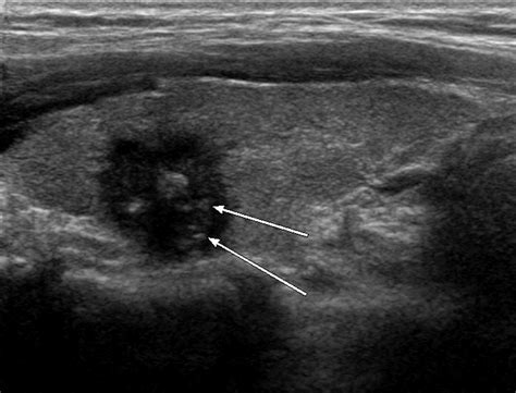 Can Vascularity At Power Doppler Us Help Predict Thyroid Malignancy Radiology