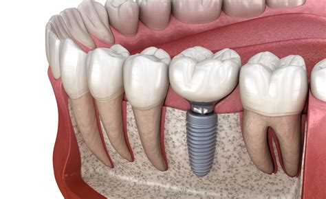 Choisir Des Implants Dentaires Battah Clinique D Implantologie