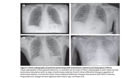 Lesion Pulmonar Aguda Pptx