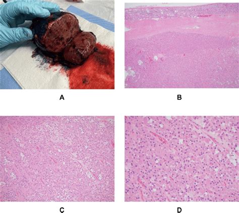 2A Gross Appearance Of The Resected Adrenal Mass Demonstrating The