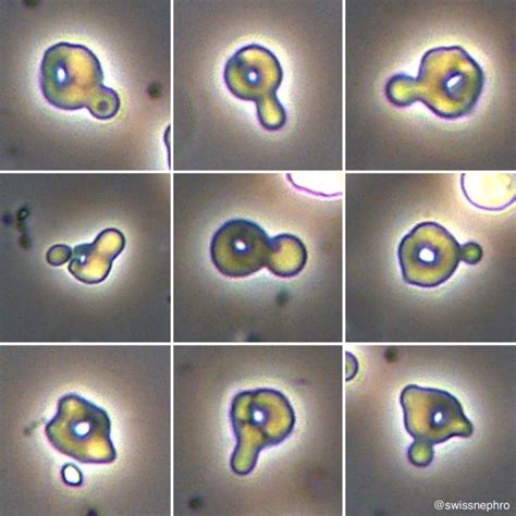 Månadens urinsediment: Dysmorfiska RBC, kännetecknet för glomerulär ...