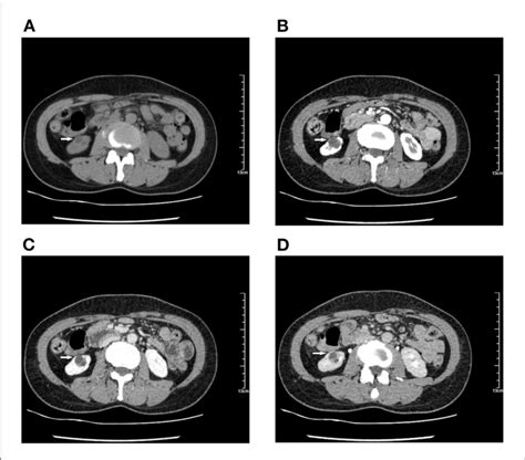 Computed Tomography CT Shows A Hypodense Mass Of 1 8 1 5 1 4 Cm