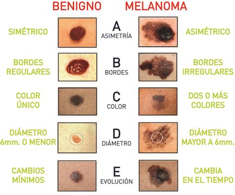 Día Mundial Del Melanoma Diagnóstico Por Imágenes