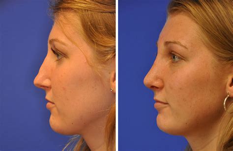 Revision Rhinoplasty Austin Tx Dr Weinfeld