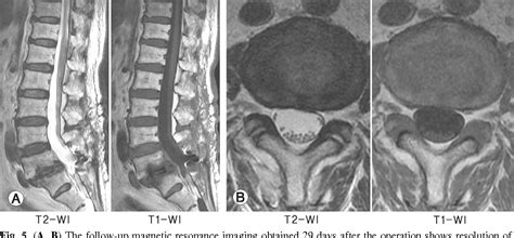 Figure 2 From Mri Changes Of The Spinal Subdural Space After Lumbar