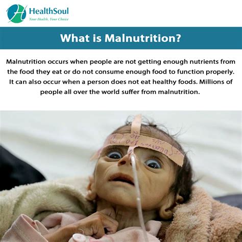 Collection 97 Pictures Images Of Malnutrition In Adults Stunning