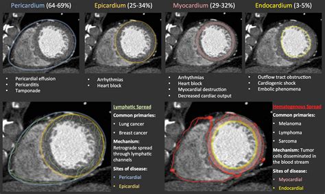 Metastasis To The Heart A Radiologic Approach To Diagnosis With Pathologic Correlation Ajr