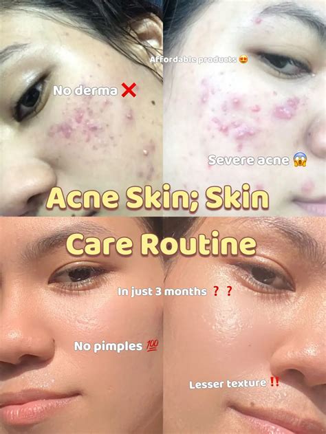 Acne Skincare Routine That Cleared My Skin 💯😱 Gallery Posted By