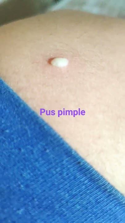 Pus Pimple Occurred Suddenly In Thigh😒😒 Youtube