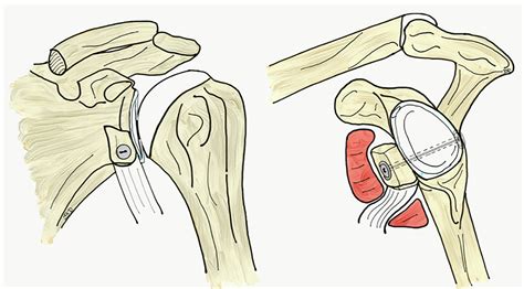 Arthroscopic Latarjet Procedure And Suture Button Fixation Can We