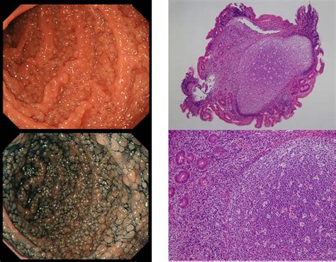 Intestinal Nodular Lymphoid Hyperplasia