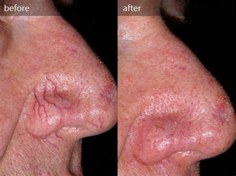 Rosacea Treatment Vancouver Paad Wellness Dermesthetics