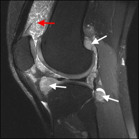 Primary Synovial Chondromatosis Radsource