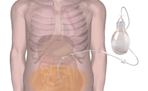 Pleurx Pleural Catheter Placement Video Youtube Otosection