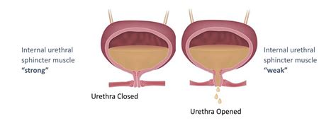 Bulkamid For Stress Urinary Incontinence