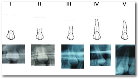 Figure From Skeletal Maturity Assessment By Comparing Cvmi Stages